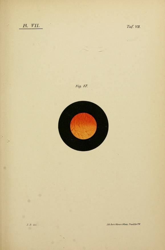 Plate VII. Cystitis in a man, 22 years old. 1893.